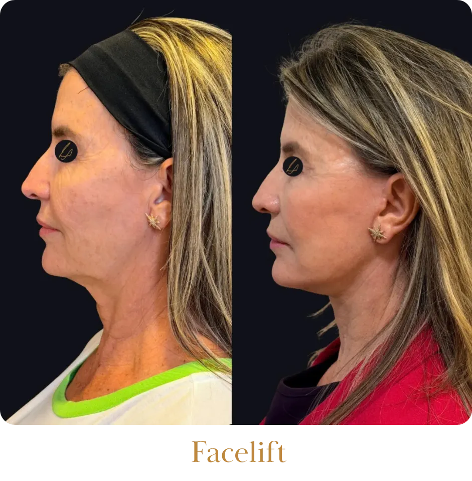 Facelift_resultado