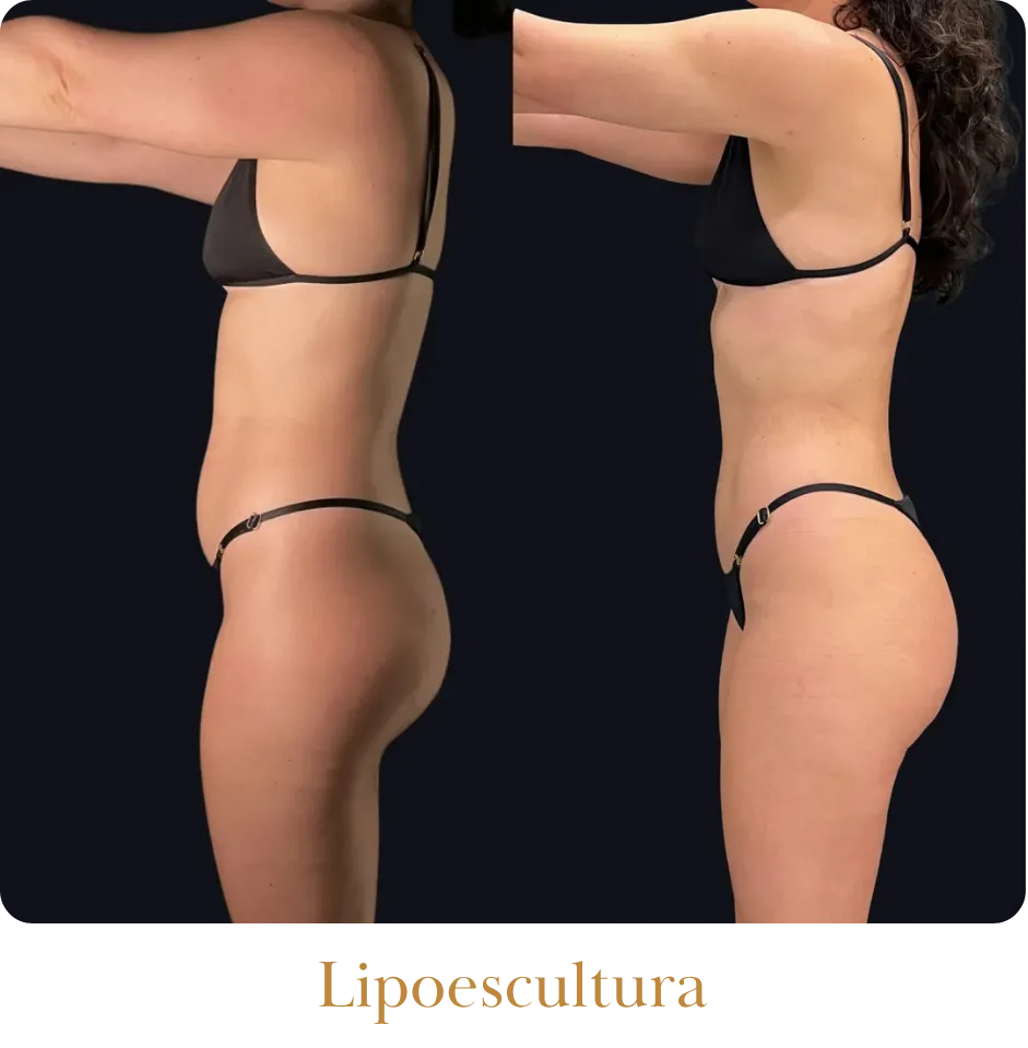 Lipoescultura _resultado