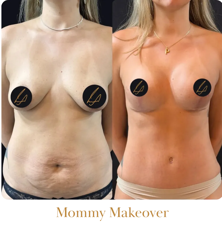 Mommy Makeover_resultado