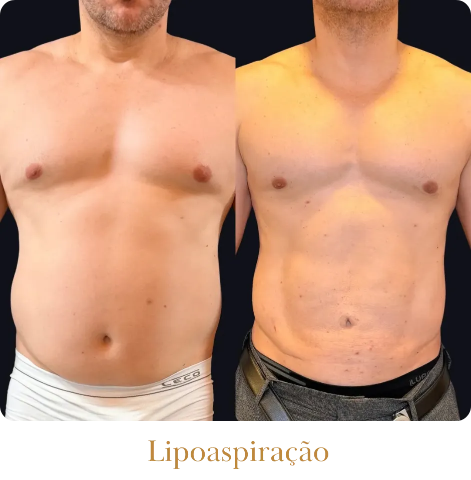 resultado-Lipoaspiração_resultado